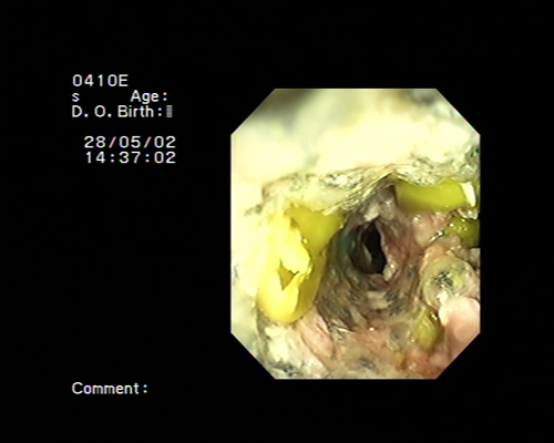 endoscopetanyaACE